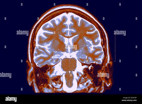 Brain mri hippocampus hi-res stock photography and images - Alamy