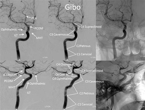 Internal Carotid Artery and Its Aneurysms | neuroangio.org