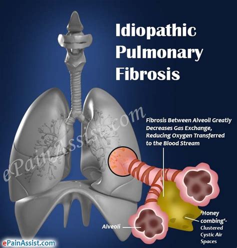 Pin on Chest Pain