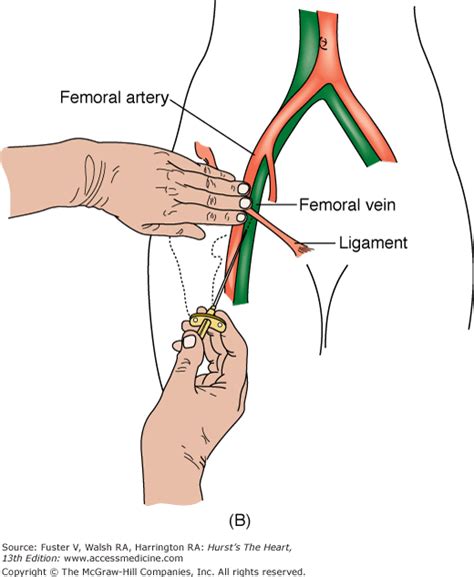 Cardiac Catheterization, Cardiac Angiography, and Coronary Blood Flow and Pressure Measurements ...