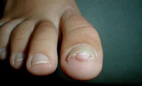 Nails Care: Subungual pyogenic granuloma Nails Diseases