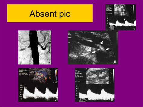 Renal doppler ultrasound