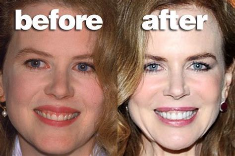 Pin on Creating Your Hollywood Smile
