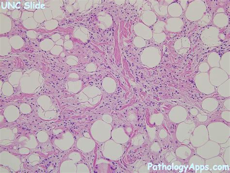 spindle cell lipoma soft tissue histology