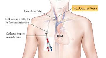 Ij Port For Dialysis