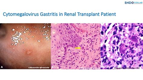 Cytomegalovirus (CMV) Gastritis - by Klaus Mönkemüller