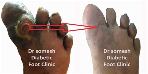 Diabetic Gangrene stages-Great Toe Base - Podiatry Doctor