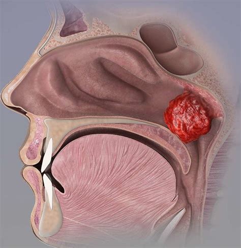 Adenoid removal: What to know and when to have it done