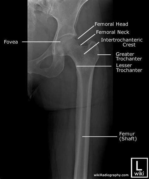 Femur Radiographic Anatomy - wikiRadiography | Radiology student, Diagnostic imaging, Medical ...