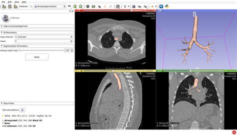 Documentation/Nightly/Modules/AirwaySegmentation - Slicer Wiki