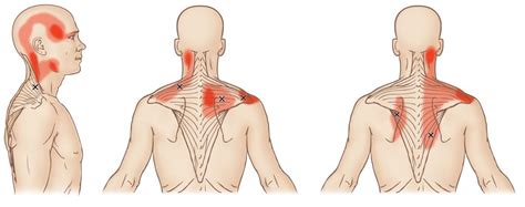 TRIGGER POINT TRAPEZIO: da dove nasce il dolore? | ManiEsperte.it