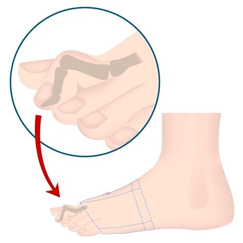 Bent Toes | Toe Deformaties | Dr Mike Smith | Orthopaedic Surgeon