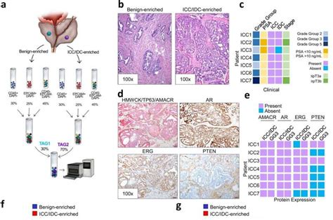 Study reveals pathways for aggressive prostate cancer subtype ...