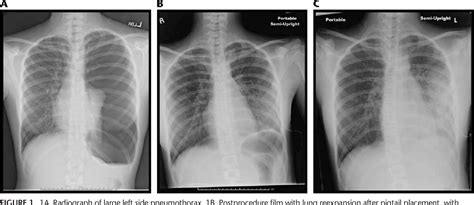 Figure 1 from Reexpansion Pulmonary Edema in Pediatrics. | Semantic Scholar