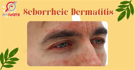 Seborrheic Dermatitis - Treatments that work!