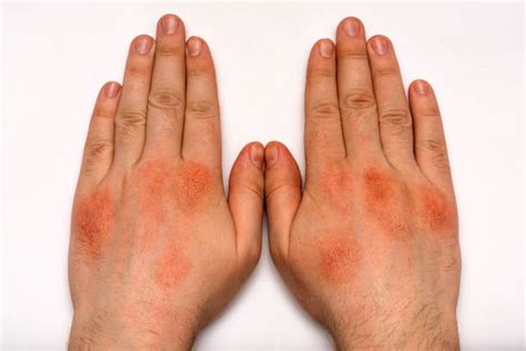 Plaque Psoriasis Stock Photos, Pictures & Royalty-Free Images - iStock