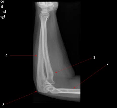 Lateral Forearm