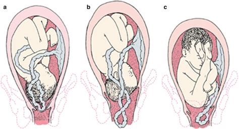 Cord prolapse: causes, risks, and treatment