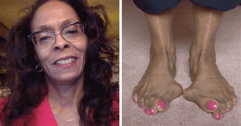 'My Feet Are Killing Me': Dana says her bunions look like jawbreakers ...