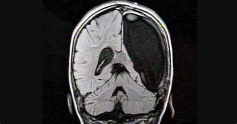 Hemispherectomy: What it Is, and Functions of This Surgical ...