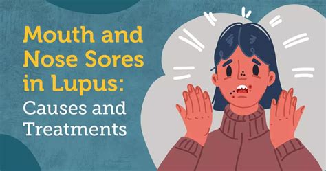 Mouth and Nose Sores in Lupus: Causes and Treatments | MyLupusTeam