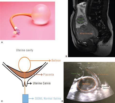 Using a cervical ripening balloon to penetrate the placenta... : Medicine