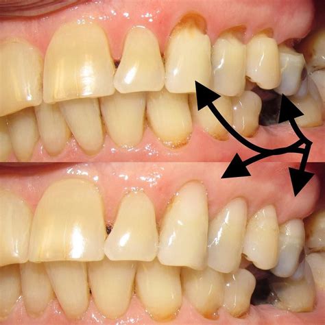 Fixing abfraction lesions | Dental problems, Dental, Dentistry