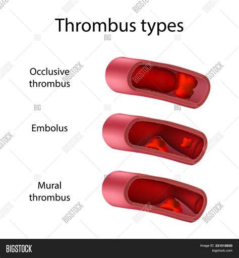 Thrombus Types, Image & Photo (Free Trial) | Bigstock