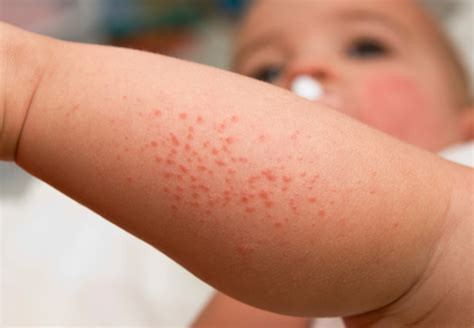 6 Symptoms Of Allergy That Everyone Should Know About