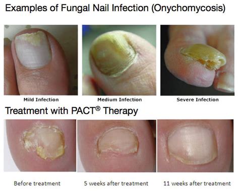 Mild Toe Fungus Treatment