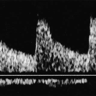 (PDF) Parvus tardus waveform suggesting renal artery stenosis - Remember the more proximal stenosis