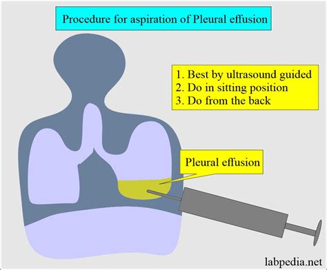 Pleural Fluid Analysis and Aspiration Procedure (Thoracentesis)