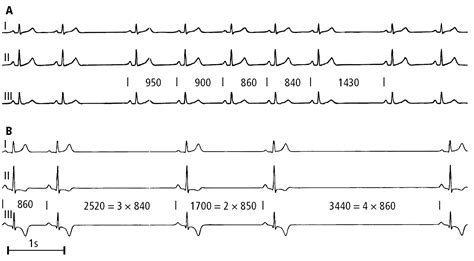 Figure 031_3152. Electrocardiography (ECG) of a patient with sinus node ...