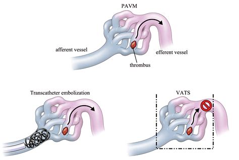 Transcatheter Embolization and Occlusion Devices Marke | Marketing ...