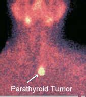 Sestamibi Scan for Parathyroid Disease. A radiografia Sestambi paratiróide localiza as glândulas ...