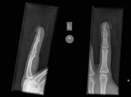 Middle finger tuft fracture | Radiology Case | Radiopaedia.org