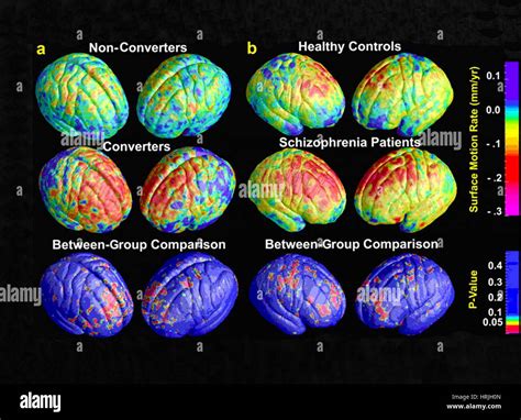 Schizophrenia brain mri hi-res stock photography and images - Alamy