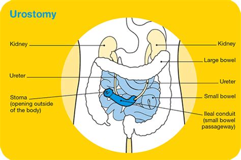 Living with a bladder reconstruction - Cancer Council Victoria