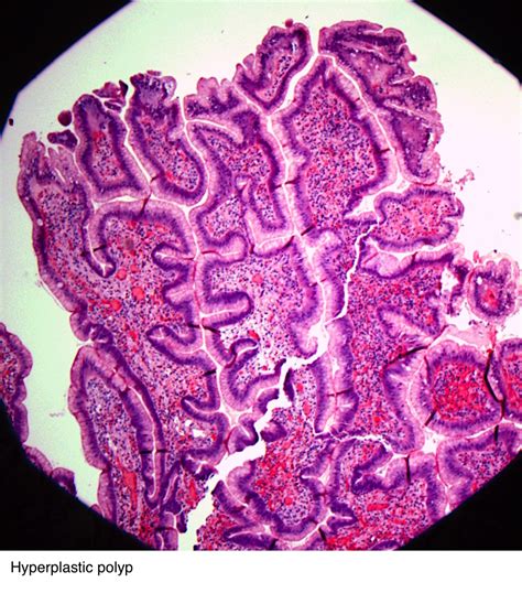 Pathology Outlines - Hyperplastic polyp