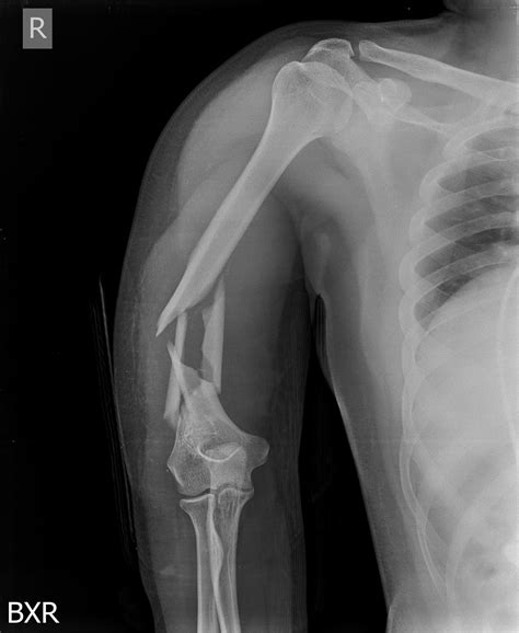 Shaft Of Humerus Fracture