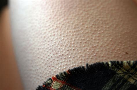 Why do we see goosebumps on our skin? | Qrius