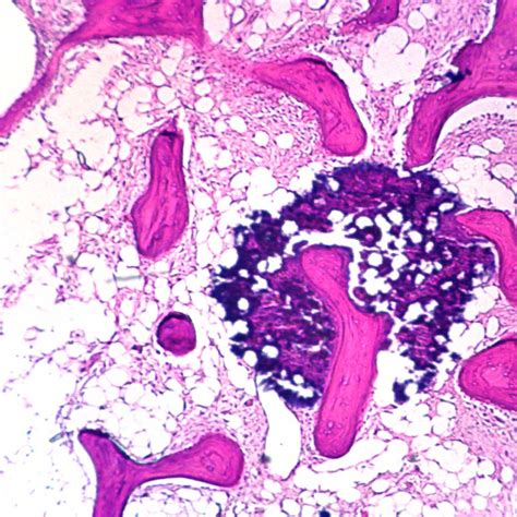 Human Osteogenic Sarcoma of Bone, sec. 7 µm, H&E Microscope Slide | Carolina Biological Supply