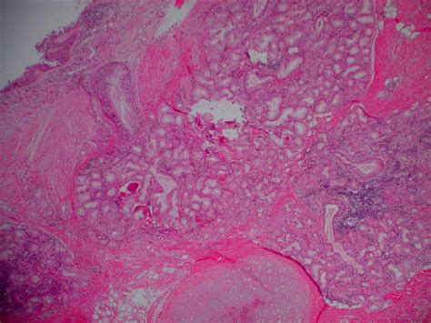 Pathology Outlines - Chronic bronchitis