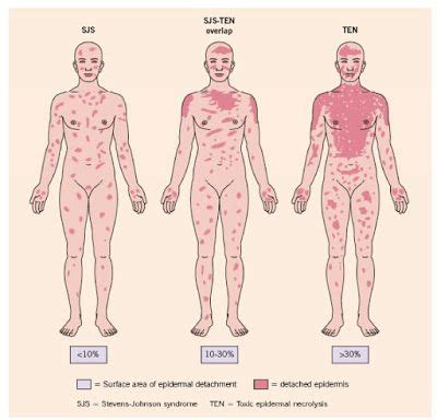 Dermapixel: Síndrome de Stevens-Johnson: Fuera alopurinol (y todo lo ...