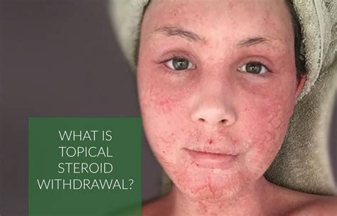 My Topical Steroid Withdrawal Syndrome Story Patient - vrogue.co
