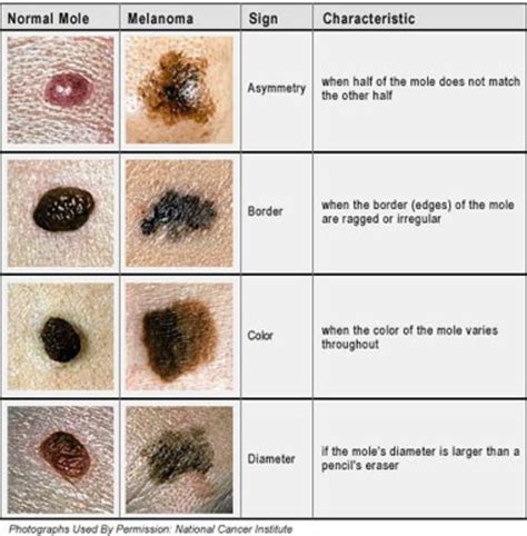 Malignant Melanoma - the mole in the skin! | hubpages