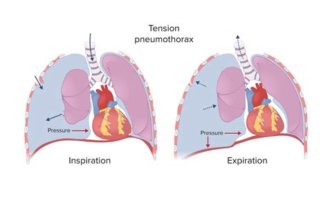 Tension Pneumothorax Diagram