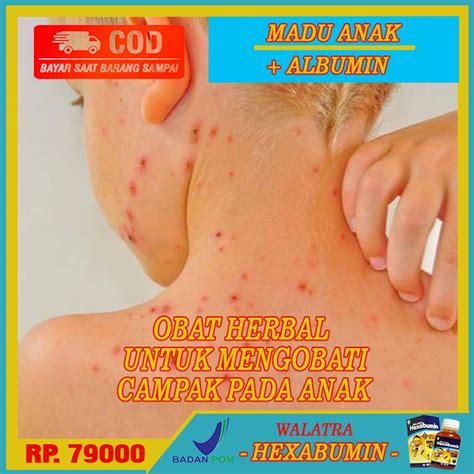 Jual Obat Campak Pada Anak, Obat Campak Tampek Rubella Pada Anak, Obat Campak Karena Virus, Obat ...