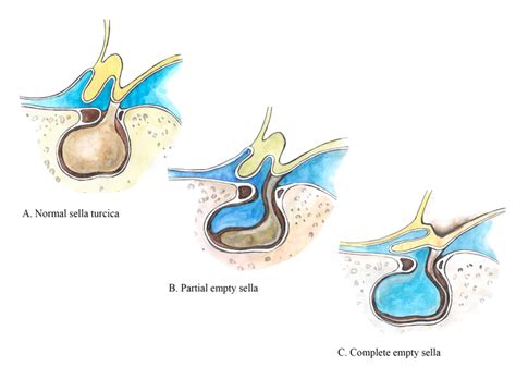 Get to know the cause of Empty Sella disease, a rare condition that attacks part of Ruben Onsu's ...