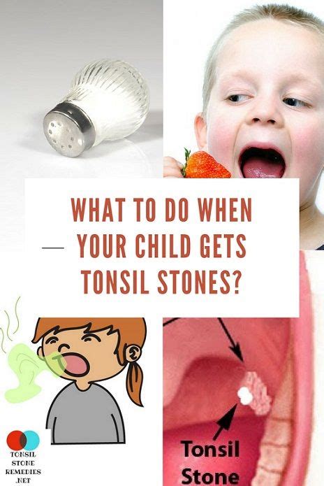 What to do when your child gets tonsil stones? - | Tonsil stones, Tonsil stone removal ...